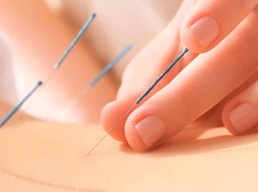 dedos sujetando agujas de acupuntura